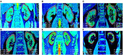 Native T1 Mapping in Assessing Kidney Fibrosis for Patients With Chronic Glomerulonephritis